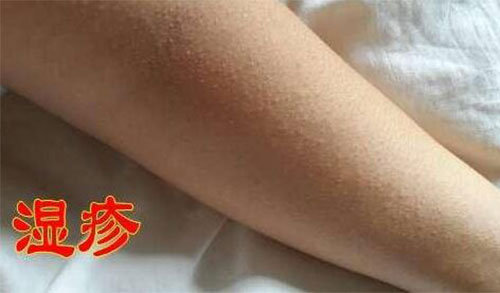 ʪ��᲻�ᴫȾ ʪ����ô��